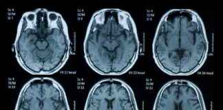 Iowans’ Changing Attitudes Towards Alzheimer’s: Survey Results owans-changing-attitudes-towards-alzheimers-survey-results